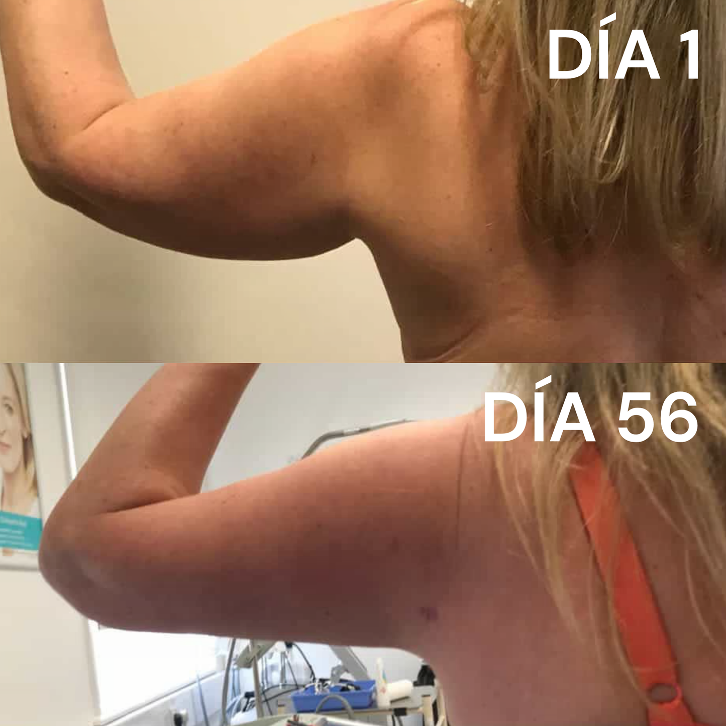 B-TENSO Crema Reafirmante Con Efecto Reductor Para Brazos